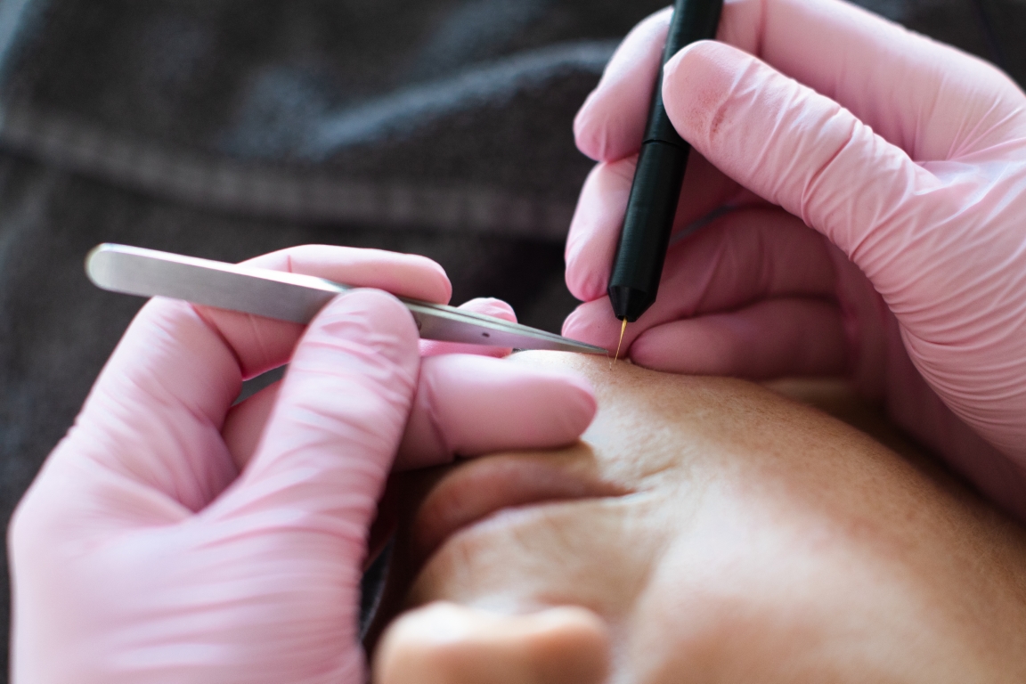Definitief ontharen bij Huidinstituut Bodyline Gouda